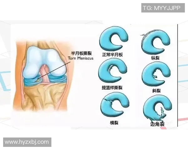 半月板损伤后的足球球员能否继续踢球及其恢复过程解析